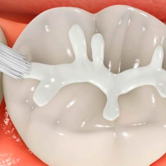 Fissure Sealants