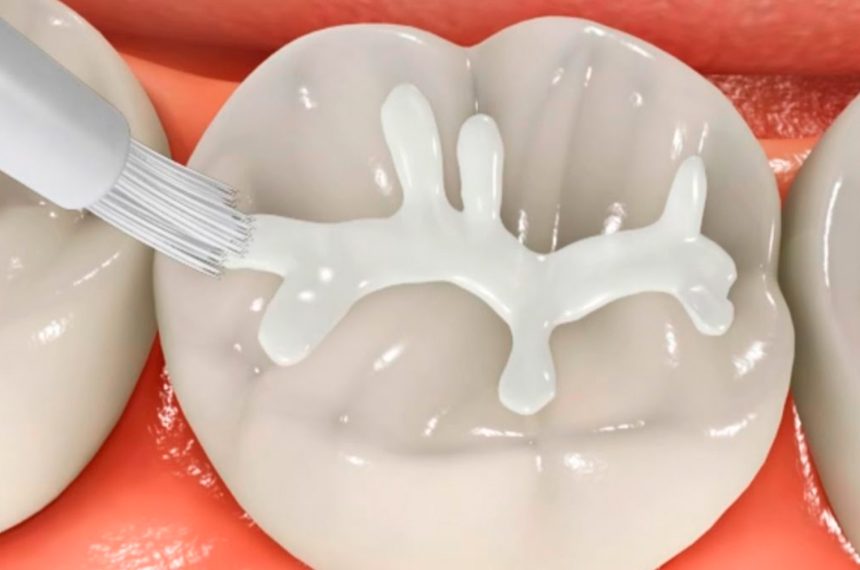 Fissure Sealants