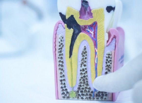 Denists Against Root Canals